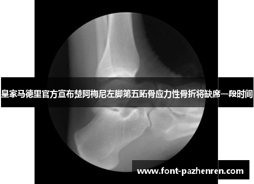 皇家马德里官方宣布楚阿梅尼左脚第五跖骨应力性骨折将缺席一段时间 皇家马德里官方宣布楚阿梅尼左脚第五跖骨应力性骨折将缺席一段时间